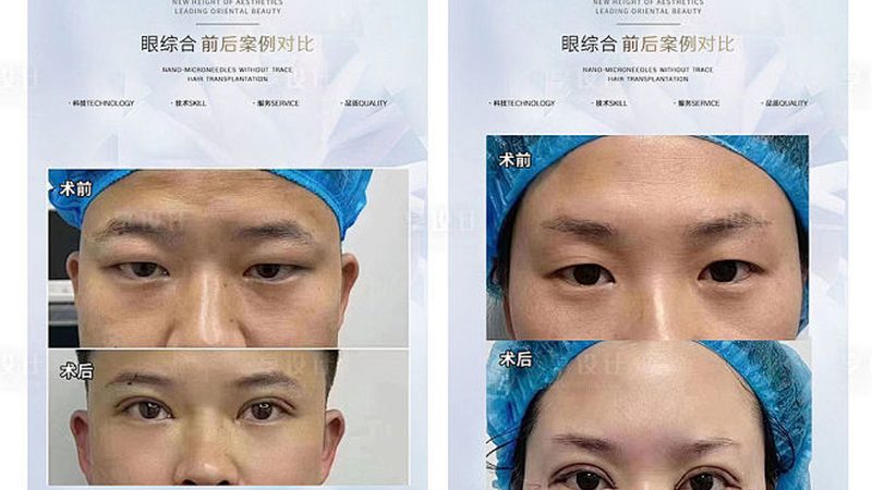 超声炮探头材质，选错了等于白做