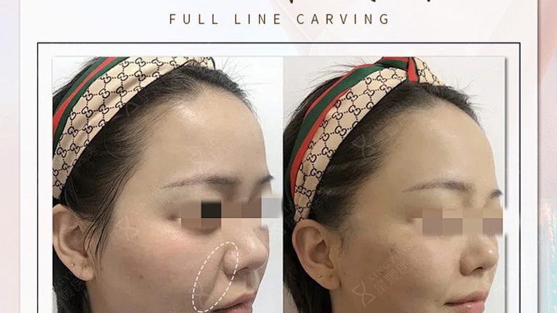 激光美容与光子嫩肤：流程解析与区别解读