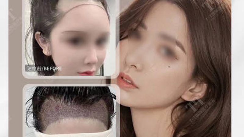 小标题：隆鼻，不仅仅是鼻子变挺
